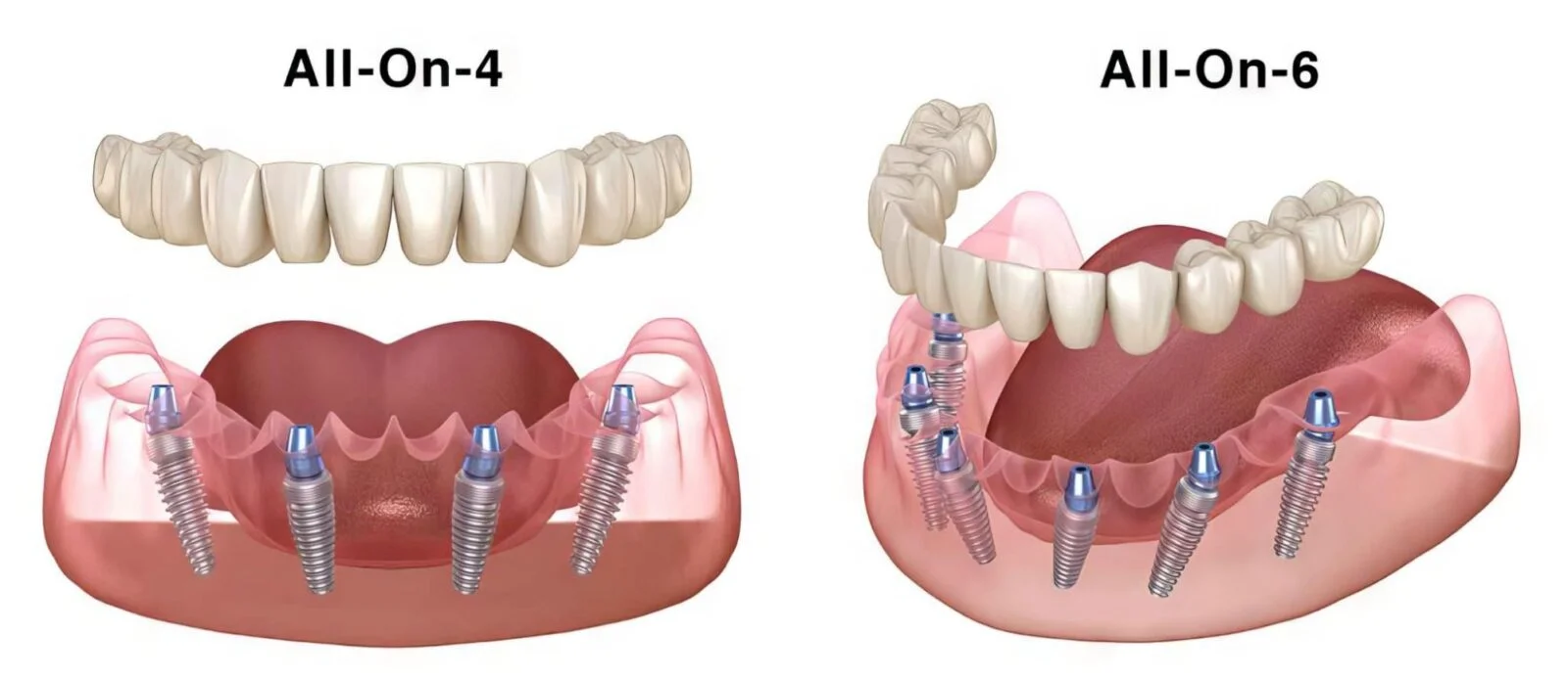 All-on-4 vs. All-on-X: What’s the Difference?