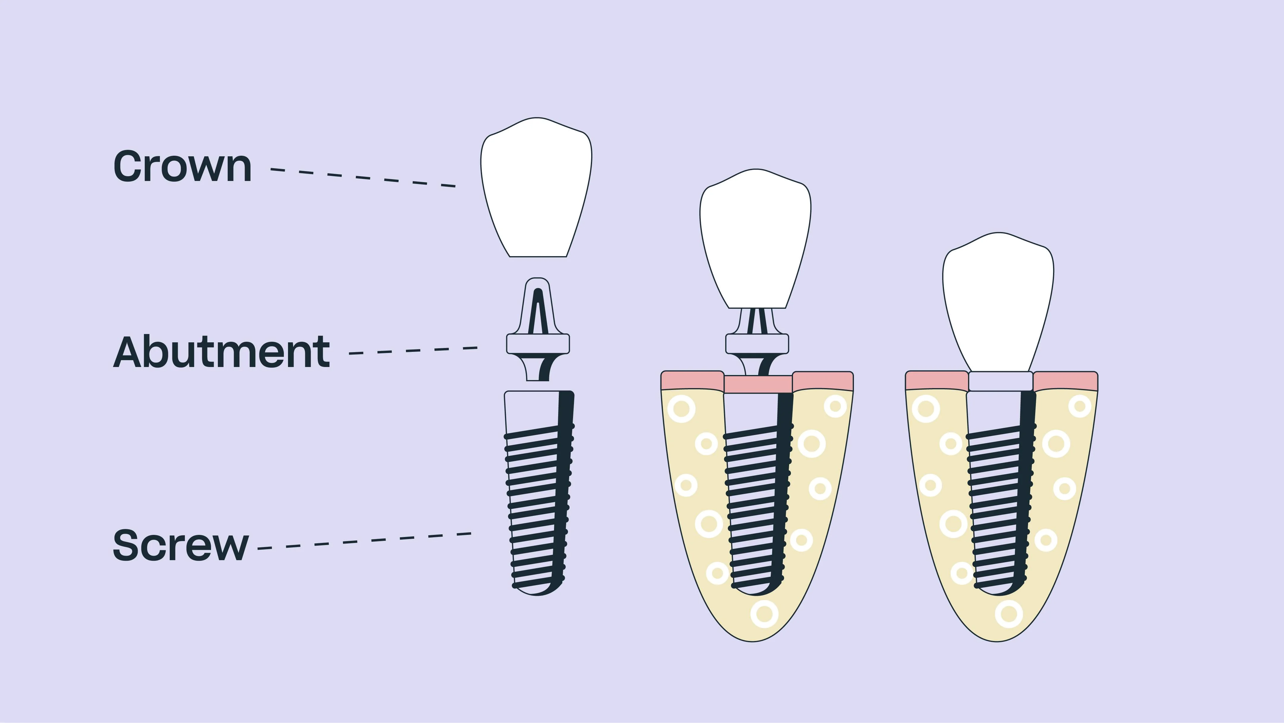 The All-on-X Procedure: Step-by-Step Guide