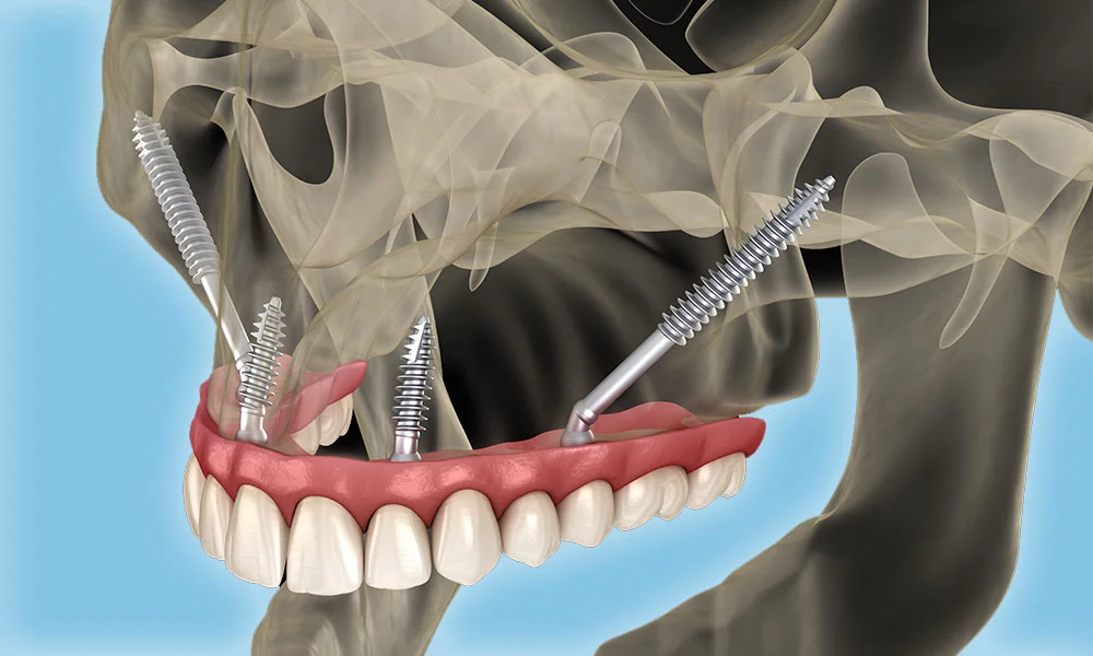 Zygomatic Implants: The Last Hope for Severe Bone Loss – Milim Dental’s Expertise in Turkey
